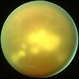 Candida Endophthalmitis